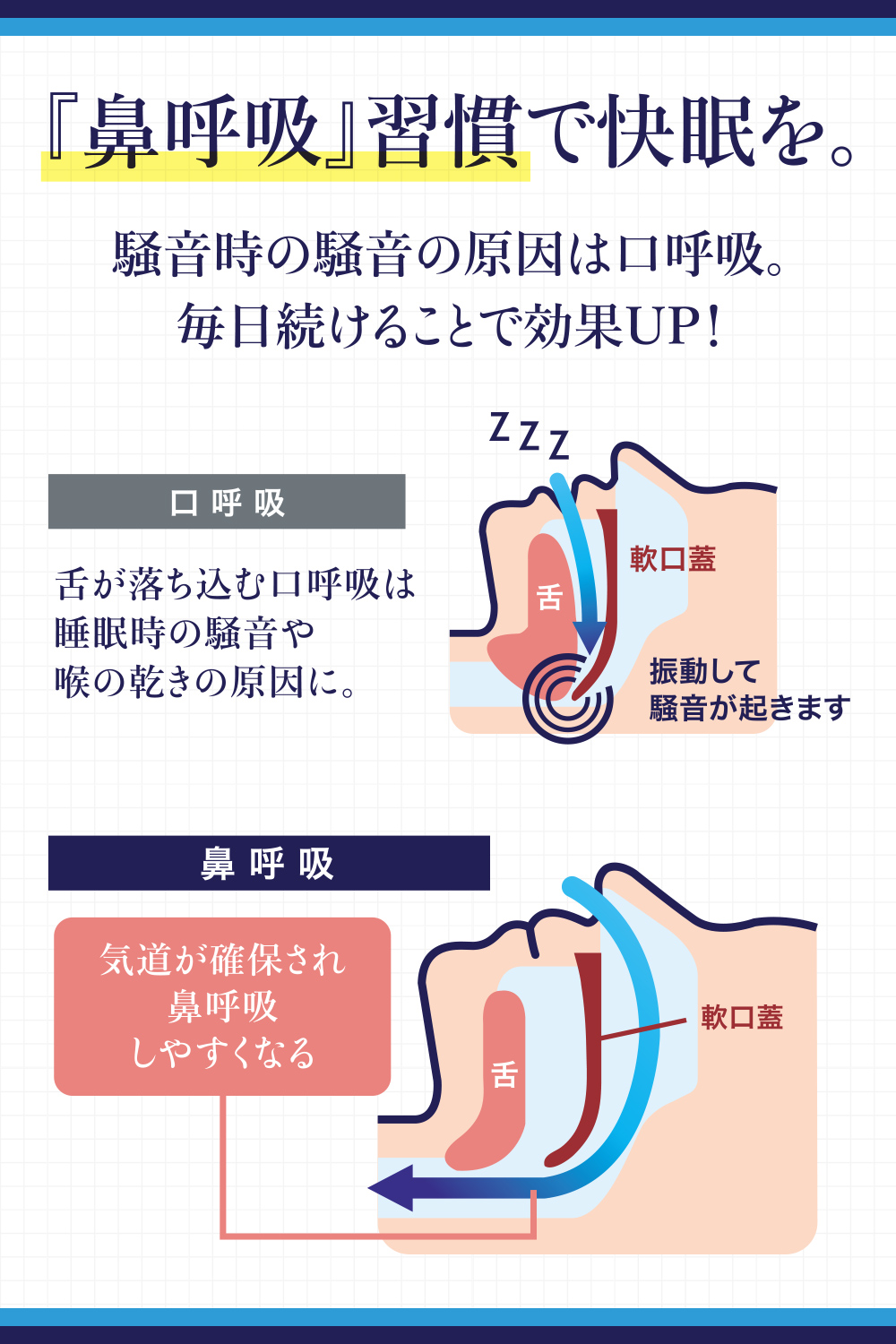  snoring prevention goods snoring prevention supporter sleeping snoring measures supporter snoring . dry prevention snoring prevention nose ... supporter . fixation cheap . goods 