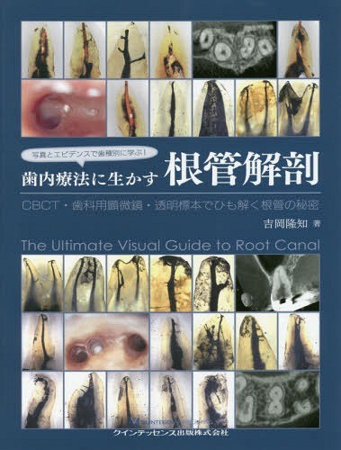写真とエビデンスで歯種別に学ぶ！歯内療法に生かす根管解剖　ＣＢＣＴ・歯科用顕微鏡・透明標本でひも解く根管の秘密 （写真とエビデンスで歯種別に学ぶ！） 吉岡隆知／著の商品画像