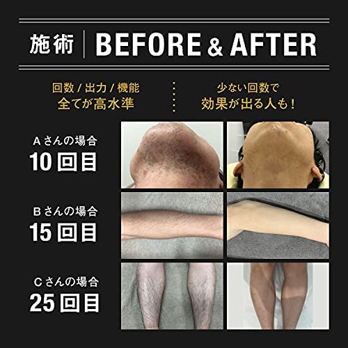 HOME CLEAR( Home clear ) depilator men's . face armpit whole body home use depilator salon class hair removal flash vio correspondence 