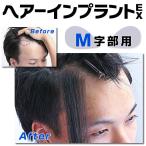 部分ウィッグ　頭皮一体増毛 ヘアーインプラントEX Ｍ字部用　かつら