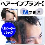 ヘアーインプラントEX Ｍ字部用　リピーターパック