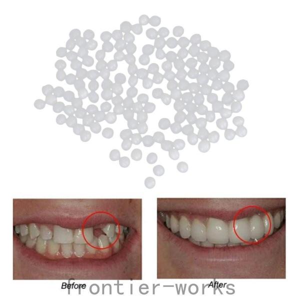 サーマルビーズ歯ベニア成形可能義歯仮歯修復ツール5g