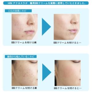 HINアクネスラボ 薬用BBクリーム(ライトベ...の詳細画像1