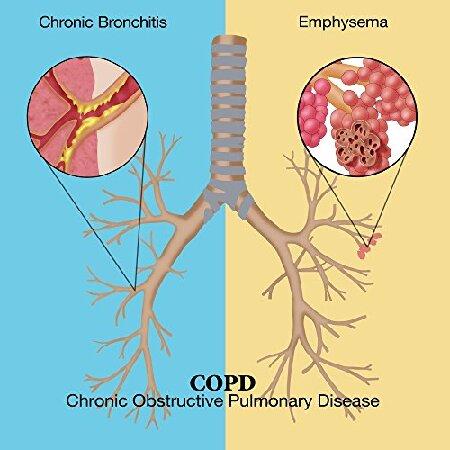 Chronic Obstructive Pulmonary Disease (COPD) Poste...