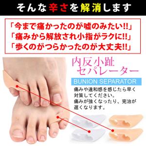 【2個セット】内反小趾セパレーター 内反小趾サ...の詳細画像2