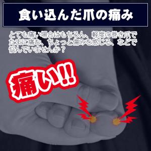 巻き爪 まきづめ ガード 巻き爪ブロック 巻き...の詳細画像1