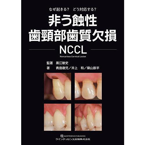 非う蝕性歯頸部歯質欠損NCCL なぜ起きる?どう対応する?/黒江敏史/著青島徹児/井上和