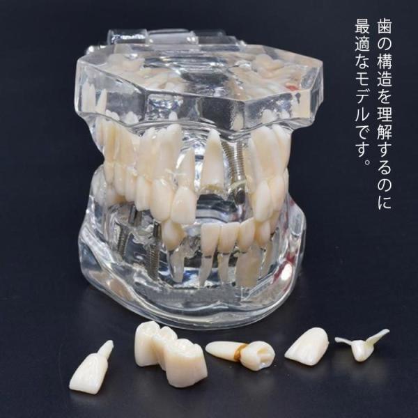 歯模型 透明 歯の模型 歯列模型 疾患展示模型 歯科模型 差し歯 歯医者 人体解剖モデル 歯 模型 ...