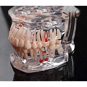 歯列模型 疾患展示模型 人体解剖モデル｜デイリーマルシェ ヤフー店
