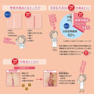 レディケア16 国内正規品 帝王切開 傷 テー...の詳細画像4