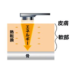 超音波治療器 イトー US-101L(バッテリ...の詳細画像5