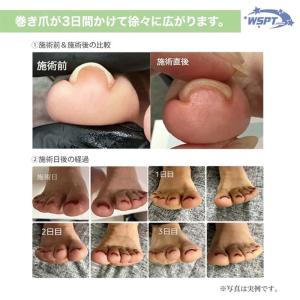 ◆WSPT フットケア フットケア用具 巻き爪...の詳細画像1