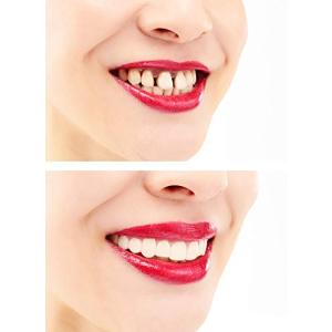 One Touch Smile ワンタッチスマイル 美容 付け歯 簡易