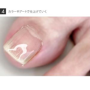 HEMAフリー 簡単巻き爪策 巻き爪策 巻き爪...の詳細画像5