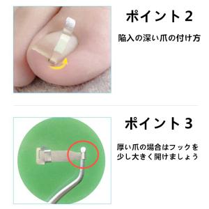 巻き爪ケアクリップ ワイヤー ガード 爪ブロッ...の詳細画像2