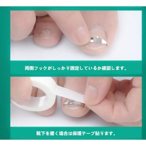 巻き爪ケアクリップ ワイヤー ガード 爪ブロッ...の詳細画像3