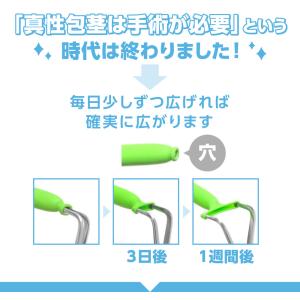 キトー君 DX 真性包茎矯正器具 グッズ 真性...の詳細画像2
