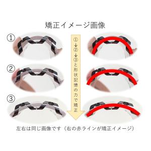 巻き爪 治し方 まきづめ 治療 ネイルエイド ...の詳細画像4