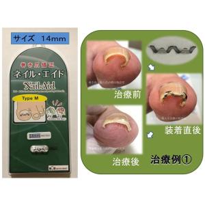 巻き爪 治し方 まきづめ 治療 ネイルエイド ...の詳細画像5