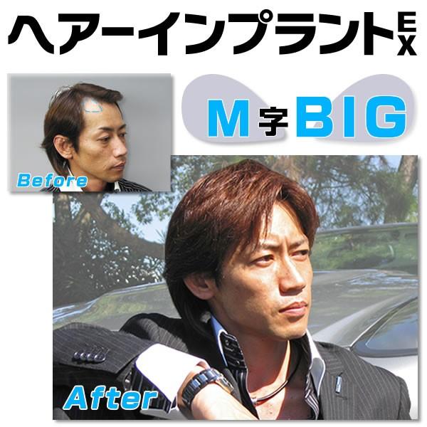 頭皮一体増毛 ヘアーインプラントEX Ｍ字部用ＢＩＧ　増毛シート　