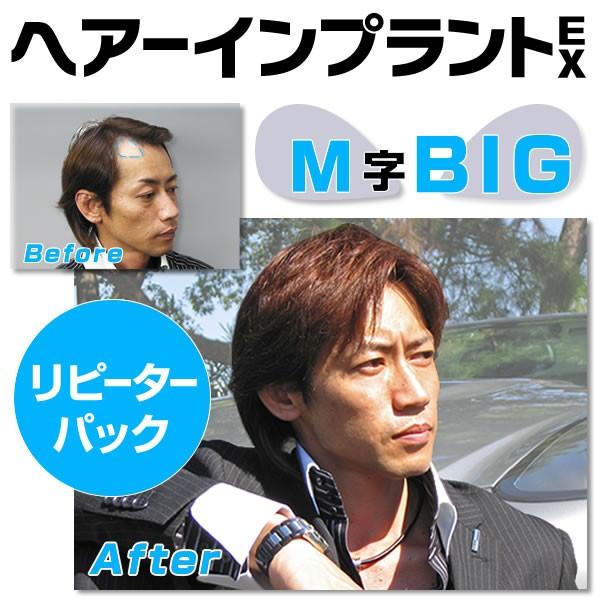 ヘアーインプラントEX Ｍ字部用ＢＩＧ　リピーターパック