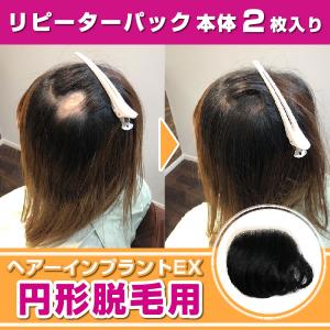 ヘアーインプラントEX　円形脱毛用　リピーターパック　※装着にはテープかシリコンが必要です｜increasehair