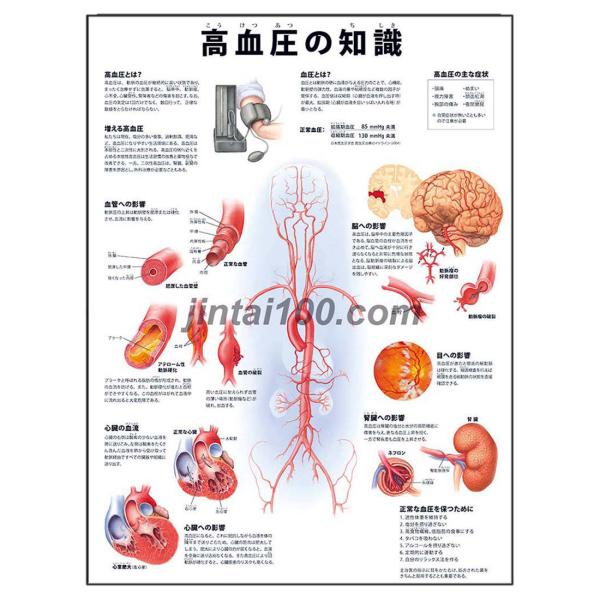 「高血圧の知識」医学ポスター ポスターB3サイズ  人体解剖学図ポスター 医学チャート