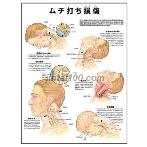 「ムチ打ち損傷」医学ポスター ポスターB3サイズ  人体解剖学図ポスター 医学チャート｜jintan-100