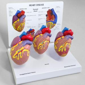 人体模型　心臓疾患　日本語訳付き　GPI Anatomicals｜jintan-100