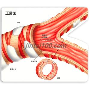「喘息と慢性閉塞性肺疾患(COPD)」型抜き絵...の詳細画像2