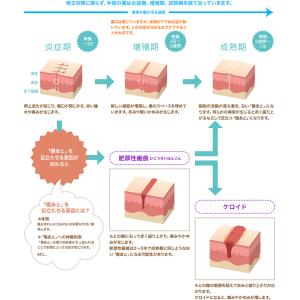 帝王切開 術後セット アトファイン 傷あとケア...の詳細画像4