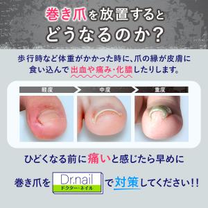 巻き爪クリップ 陥入爪 まきずめ まきづめ 巻...の詳細画像3