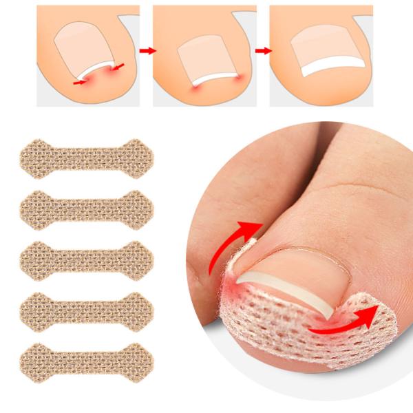 巻き爪テープ 80枚 まきづめ テープ 巻き爪 爪 ケア 巻爪 巻き爪対策 伸縮タイプ 巻き爪ケアテ...