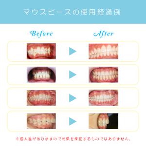 デンタルマウスピース 2個セット 歯列 マウス...の詳細画像3