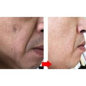 薬用シミ取りクリーム 男性用 Beクリアホワイ...の詳細画像2