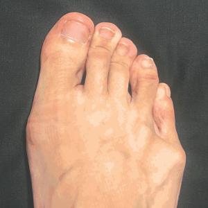 外反母趾 内反小趾 サポーター 足指 広げる ...の詳細画像1