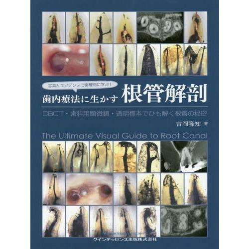 【送料無料】[本/雑誌]/写真とエビデンスで歯種別に学ぶ!歯内療法に生かす根管解剖 CBCT・歯科用...