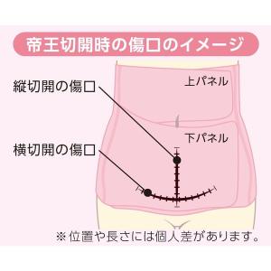 オオサキメディカル dacco 帝王切開用伸縮...の詳細画像5