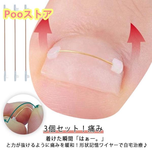 補正 ブロック 親指 足 巻き爪 巻き爪ワイヤーガード 3個セット！痛み 4ヶ月 テープ 陥入爪 矯...