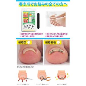 まきづめリフト ヤスリ付 《4本爪、巻き爪 矯...の詳細画像2