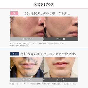 脱毛器 MYTREX 公式 MiRAY 光美容...の詳細画像5