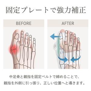 #40 外反母趾サポーター 寝る時 外反母趾 ...の詳細画像2