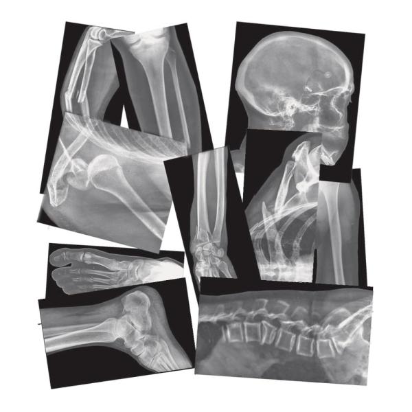 Roylco Rー5914 Broken Bone Compound Fracture XーRays