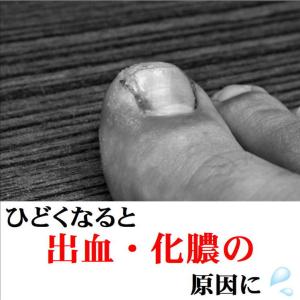 巻き爪 矯正 プレート 自力で治す 足の爪ケア...の詳細画像5