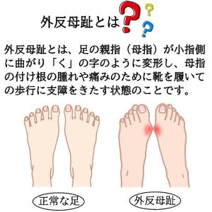 外反母趾 矯正 靴下 レディース 婦人 ソック...の詳細画像2