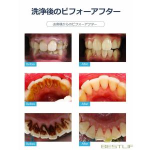 歯石取り 超音波口腔洗浄器 内視カメラ搭載 超...の詳細画像3