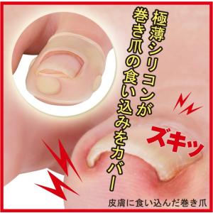 勝野式 巻き爪 &amp; サムリング 2個組   巻きづめ 矯正 痛み ブロック   防止 ワイヤー ハード 巻き爪クリップ 巻き爪用ク