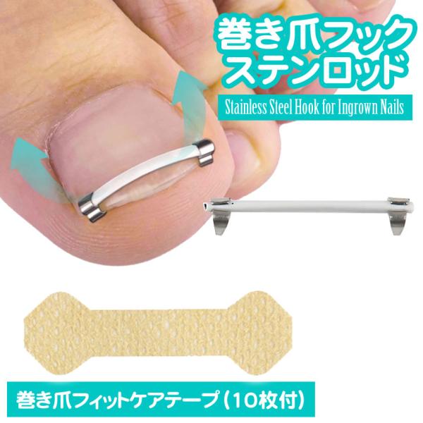 巻き爪 フックステンロッド まきづめ クリップ ネイルケア 形状記憶 陥入爪 巻爪ケア 矯正 巻き爪矯正 巻きづめ 足の巻き爪 防止 巻き爪ケア