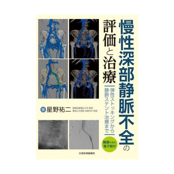 慢性深部静脈不全の評価と治療　弾性ストッキングから静脈ステント治療まで / 星野祐二　著