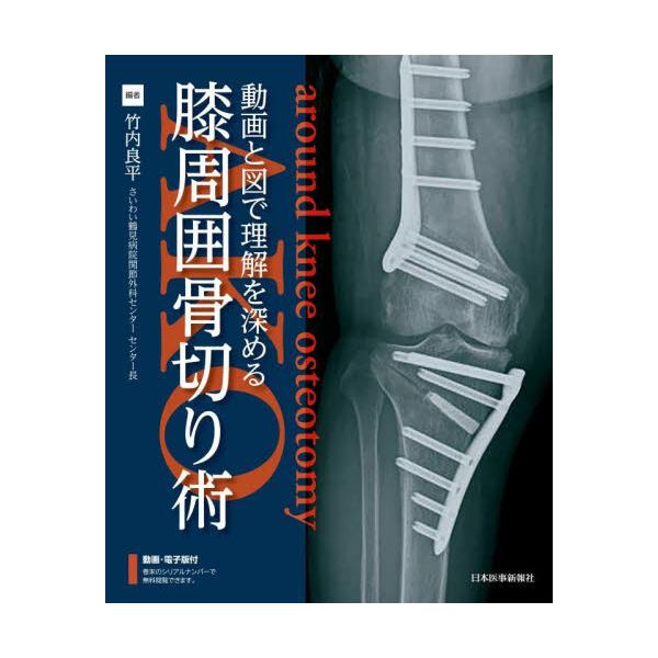 膝周囲骨切り術のすべて Around the Knee Osteotomy 膝周囲骨切り術